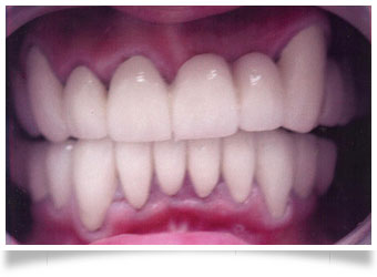 full restored dentures