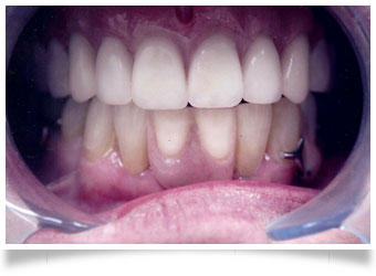 Partial dentures after