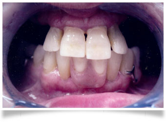 partial dentures before